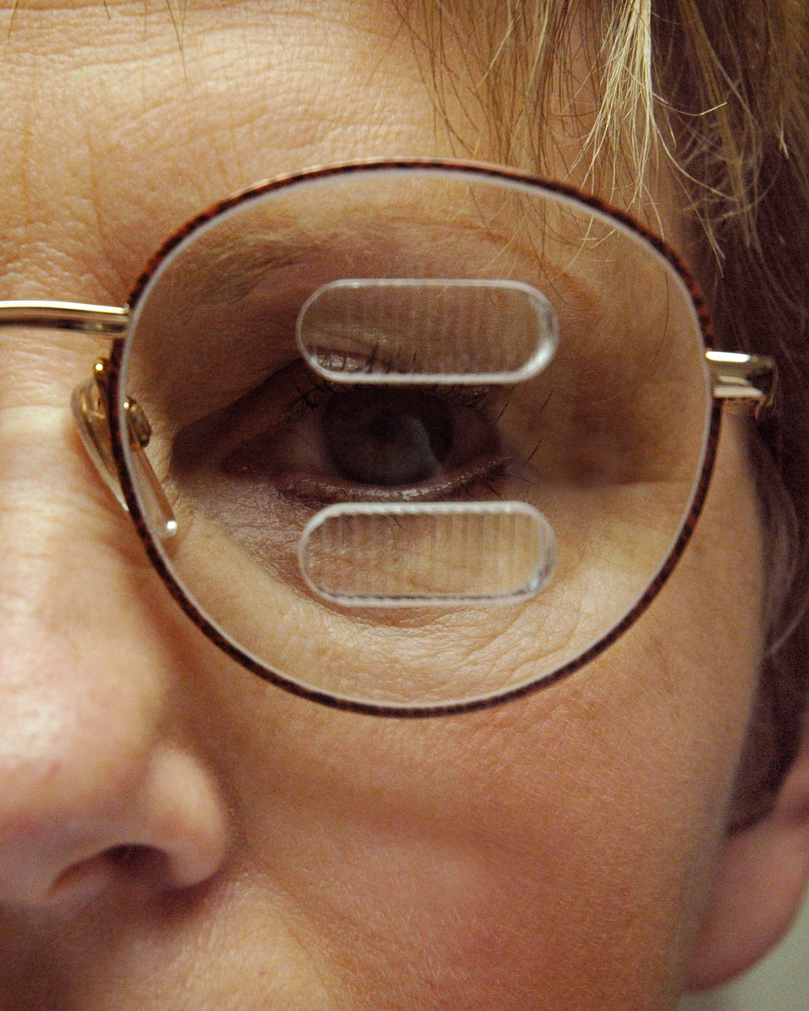 Prism Glasses for Post-Concussion Patients