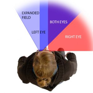 "Illustration demonstrating the function of the Peli lens, with arrows showing field of vision expansion for enhanced mobility.