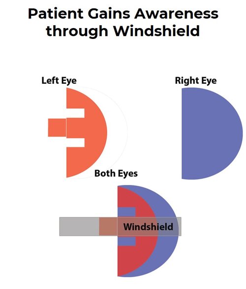 Patient Gains Improved Spatial Awareness Through Peli lens Windshield