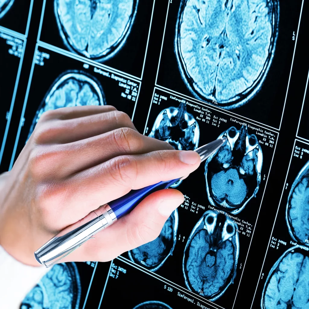 Close-up view of hand pointing at a series of brain scan images on a computer screen with a pen.