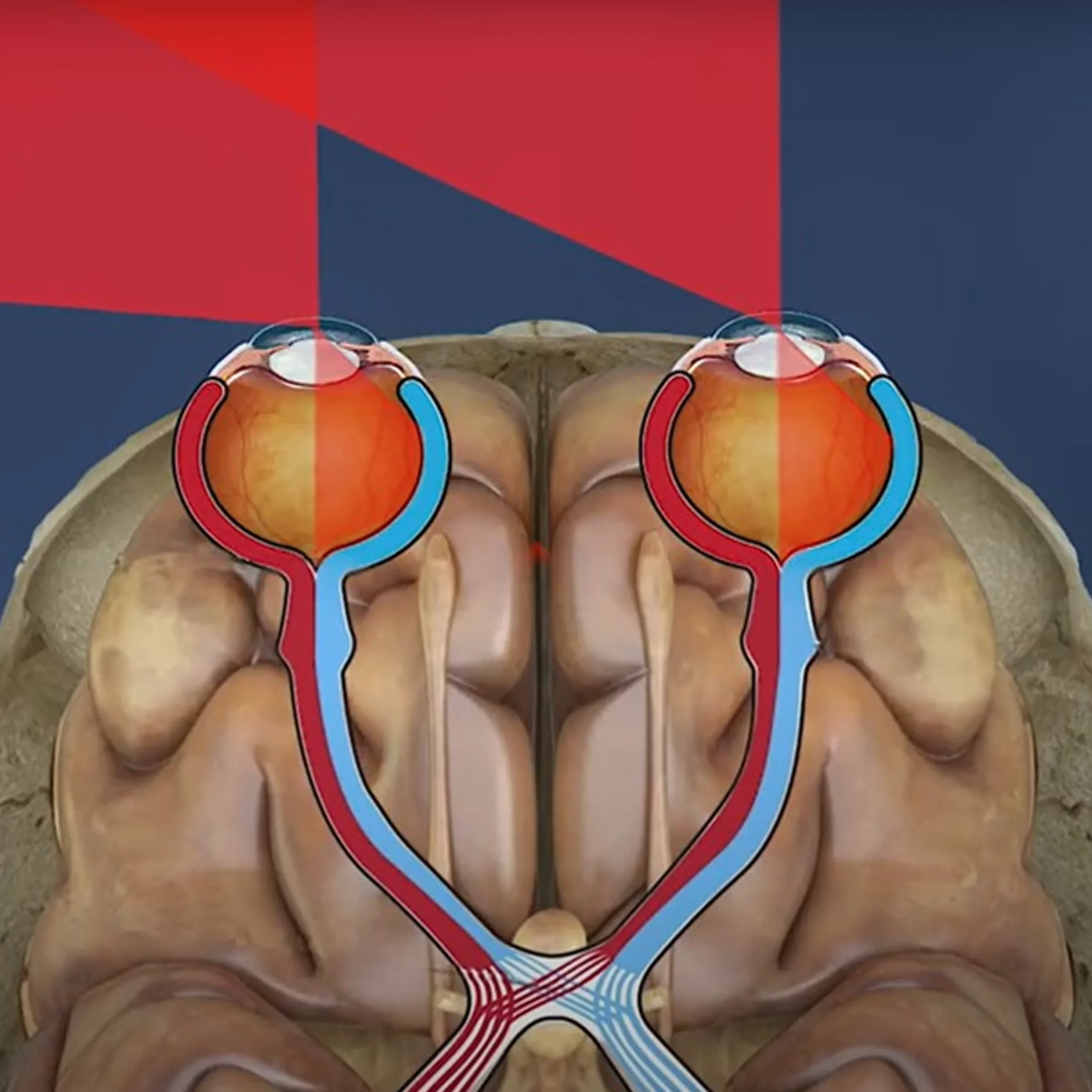 Brain diagram showing the effects of homonymous homonopia.