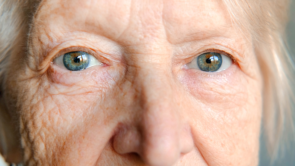 Close up of an elderly, female low vision patient with blue/grey eyes Close up of an elderly, female low vision patient with blue/grey eyes