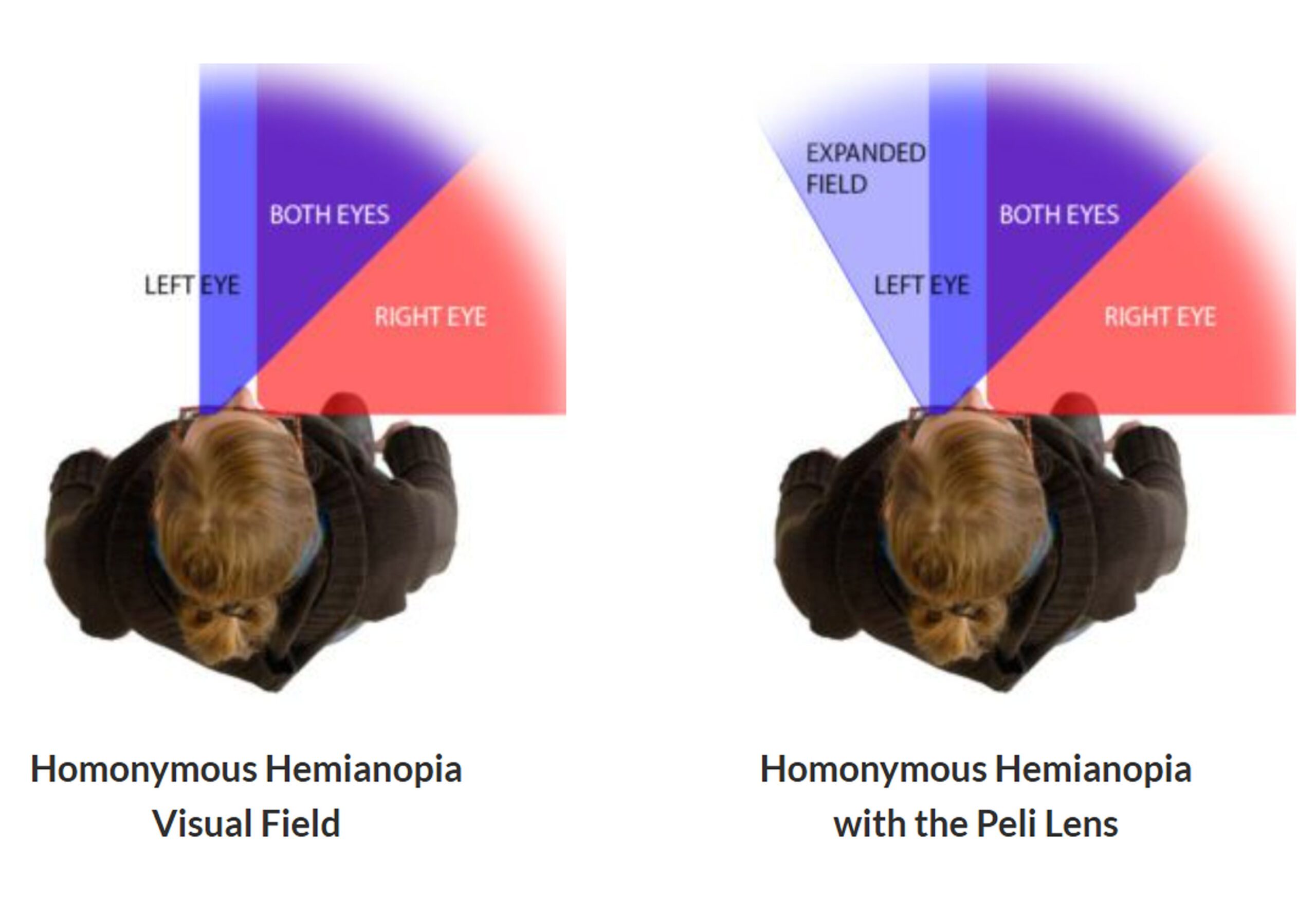 homonymous-hemianopia-peli-lens