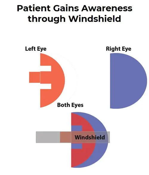 Chadwick Optical Windshield lens helps patients regain full peripheral awareness by merging visual fields.
