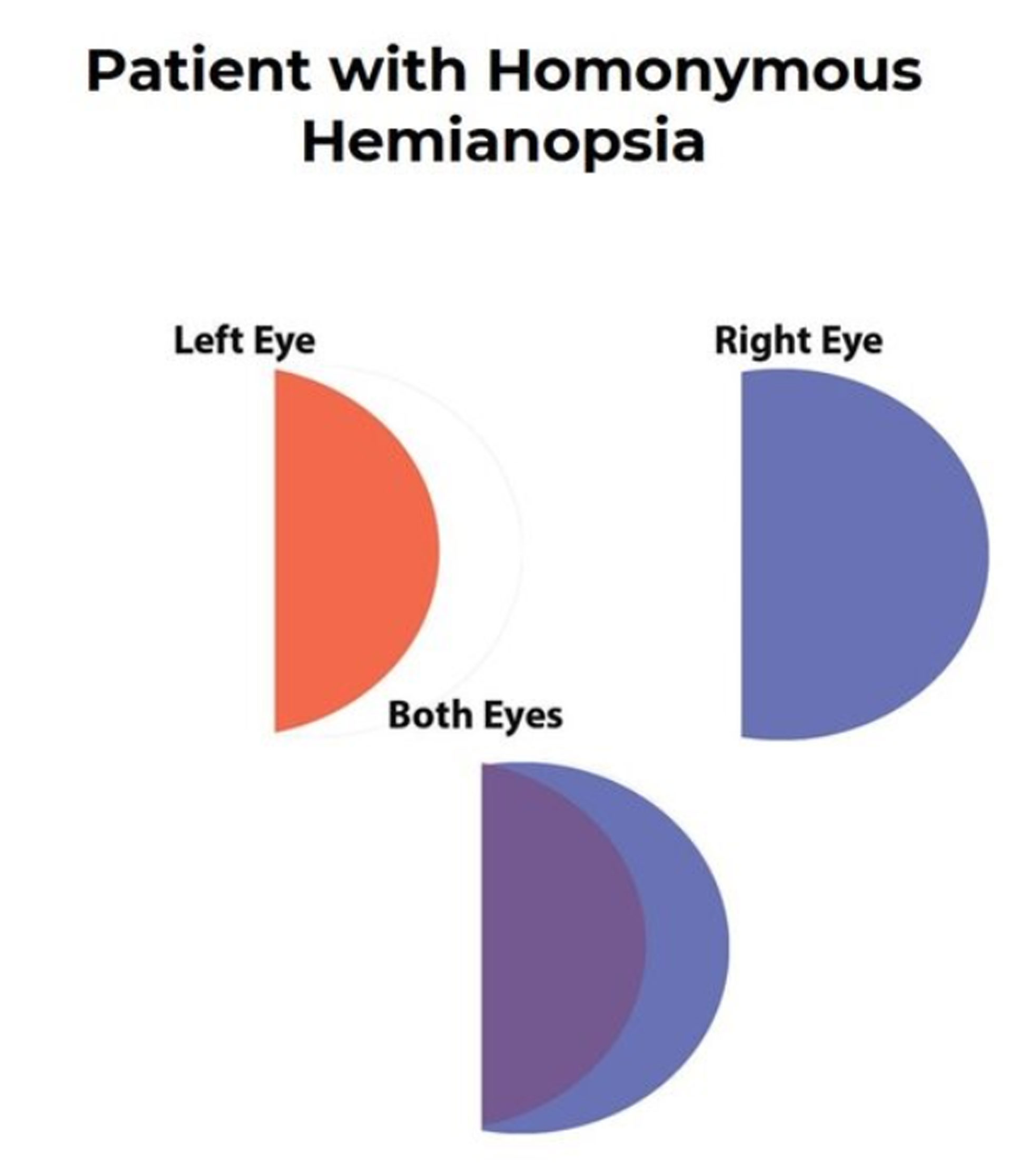 Chadwick Prism Lenses: Helping restore side vision for patients with Homonymous Hemianopsia, reducing missed steps and bumps.