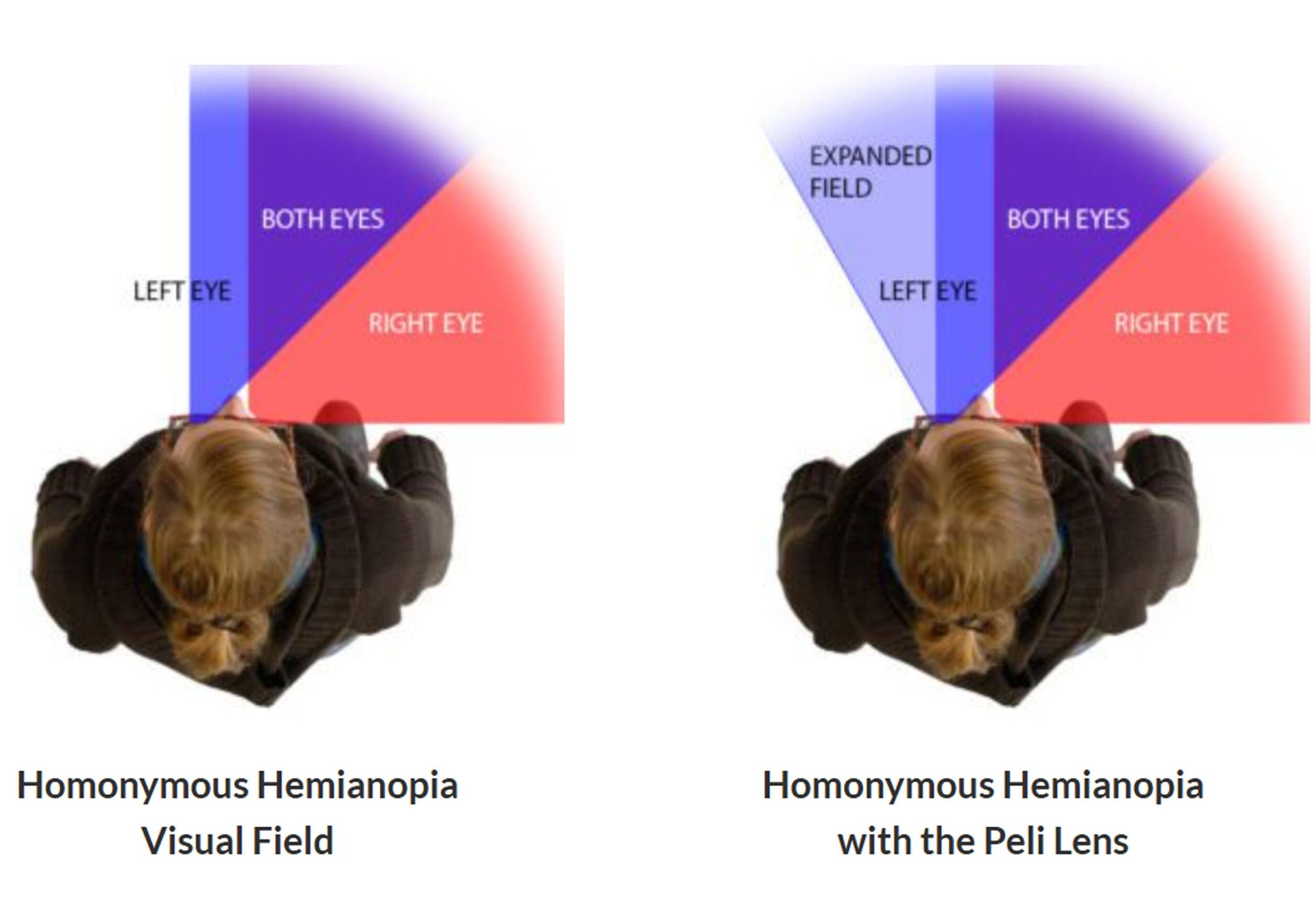 homonymous-hemianopia-peli-lens