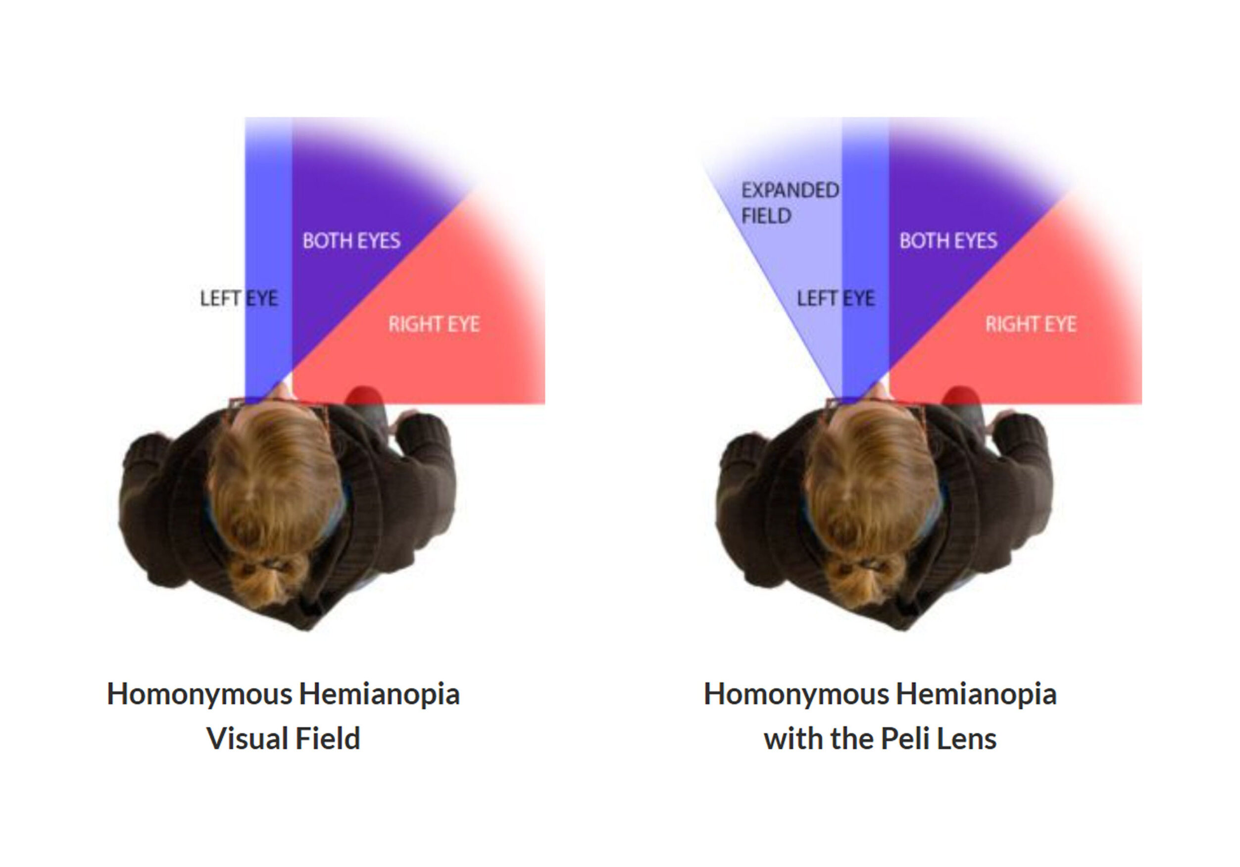 homonymous-hemianopia-peli-lens homonymous-hemianopia-peli-lens