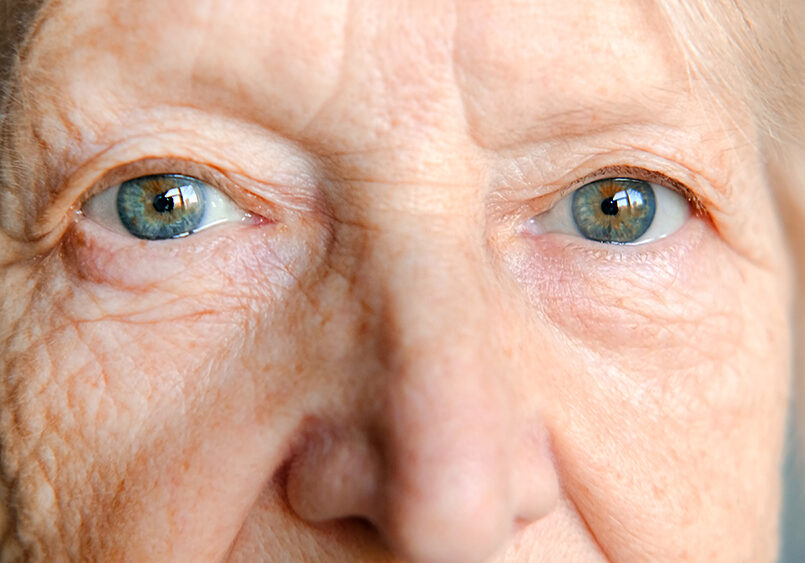 Close up of an elderly, female low vision patient with blue/grey eyes